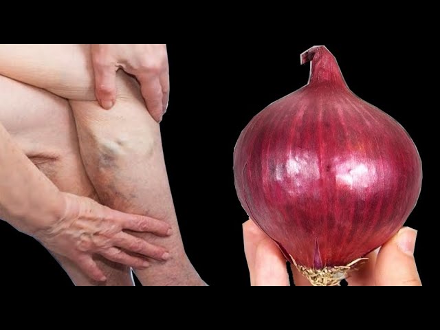 Soothe Your Pains with Mom’s Natural Onion Remedy