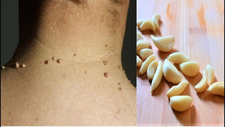 Remove Skin Tags: Easy Home Remedies with Garlic